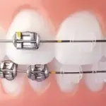 Full Mouth Reconstruction Conroe: Restore Your Smile with Confidence