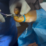 Kids Ingrown Toenails: Safe Care and Quick Relief