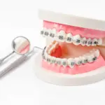 Orthodontics Cost: Transparent Pricing for Braces, Aligners & Invisalign