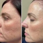 Nano Needling Facial for Acne: Clearer Skin, Gentle Care
