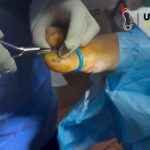 Ingrown Toenail Care: Quick Relief and Same-Day Surgery Options